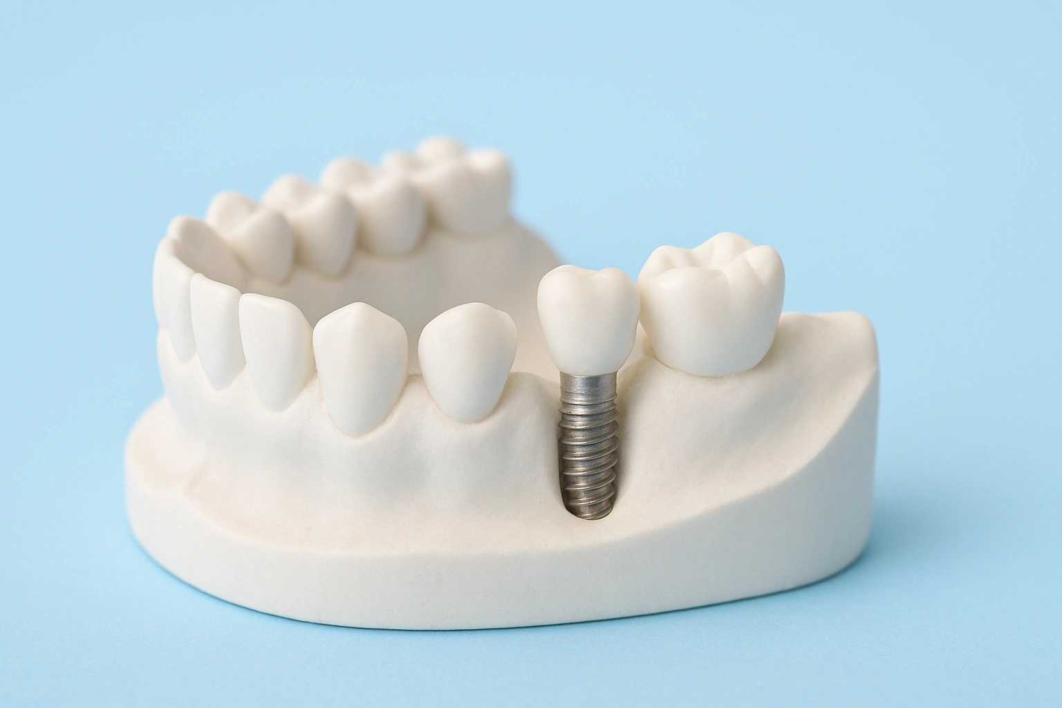 بهترین مرکز تخصصی ایمپلنت برای دندان در کرج