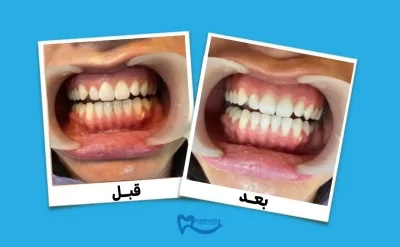 بلیچینگ چقدر دندان را سفید میکند؟
