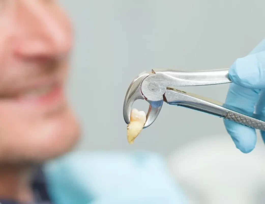 مراقبت‌ های بعد از کشیدن دندان