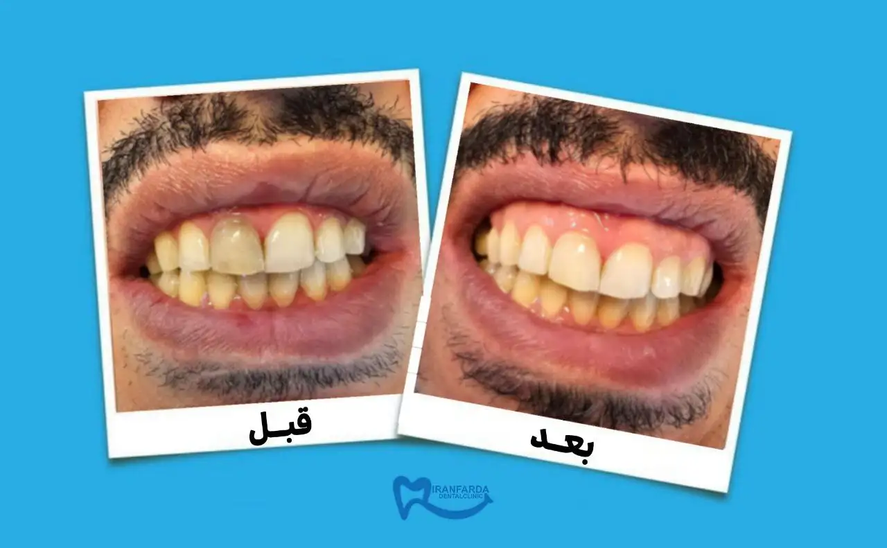 قیمت بلیچینگ دندان در کرج