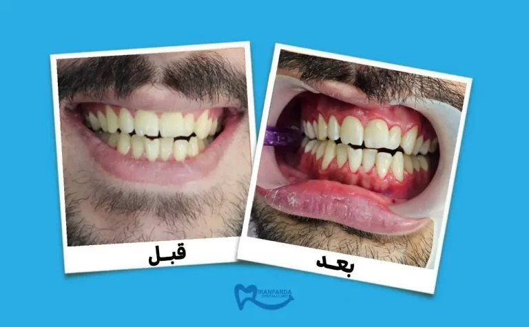 قیمت بلیچینگ دندان در کرج