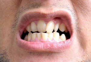 ایا دندان های کج را میشود لمینت کرد؟