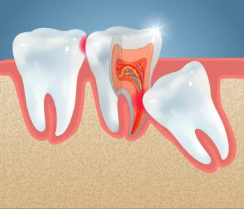 اگر ریشه دندان عقل در لثه بماند چه میشود؟