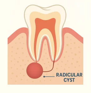 درمان کیست دندان عصب کشی شده