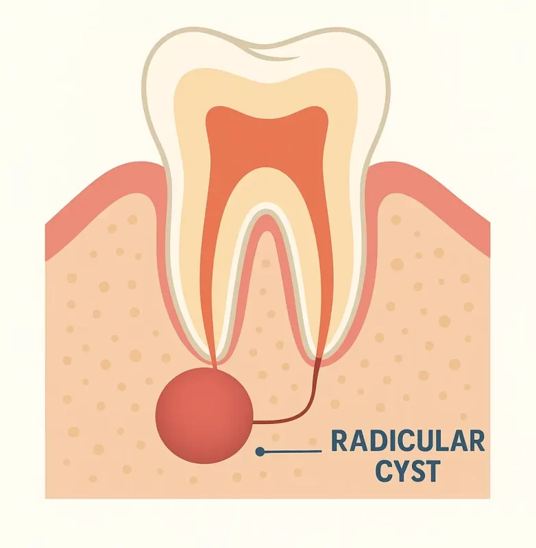 درمان کیست دندان عصب کشی شده