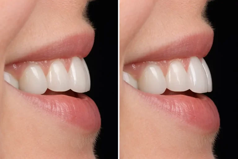 آیا کامپوزیت باعث جلو آمدن دندان می شود؟