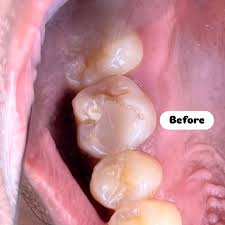 اگر پانسمان دندان عصب کشی شده افتاد چه کنیم؟