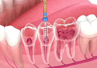 درمان ریشه مجدد در کرج