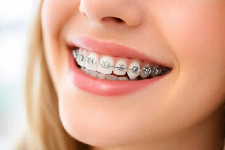 نقش ارتودنسی دندان نیش: